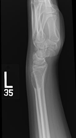 Telangiectatic Osteosarcoma Radiology Reference Article Radiopaedia Org