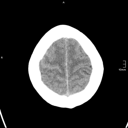 Convexal Subarachnoid Hemorrhage Radiology Reference Article