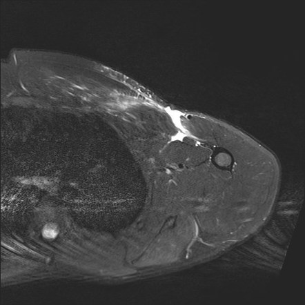 Pectoralis Major Tear Image Radiopaedia Org