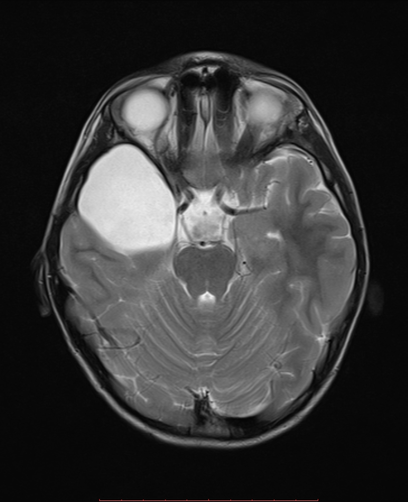 Middle Cranial Fossa Arachnoid Cyst Galassi Type II Image