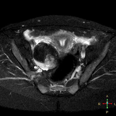 Ovarian Dermoid Cyst Image Radiopaedia Org