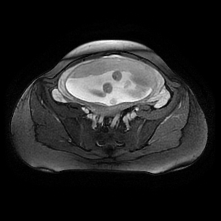 Septo Optic Dysplasia Fetal Mri Image Radiopaedia Org