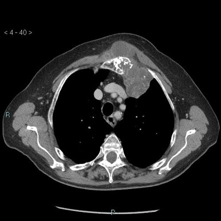 Chondrosarcoma Radiology Reference Article Radiopaedia Org