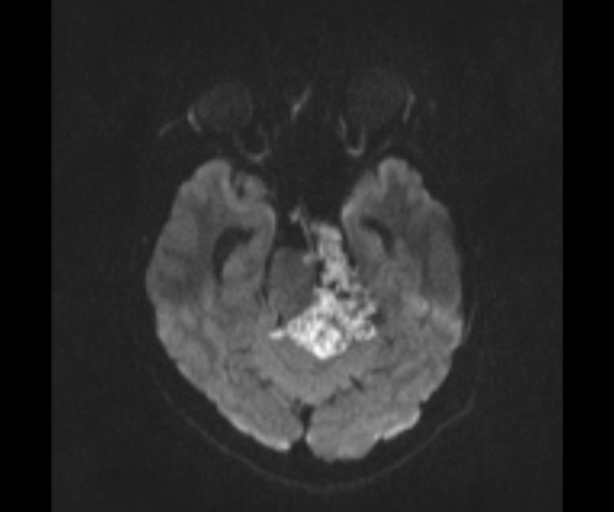 Cerebellopontine Angle Epidermoid Cyst Image Radiopaedia Org