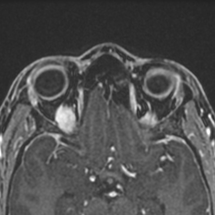 Myositic Orbital Pseudotumor Image Radiopaedia Org