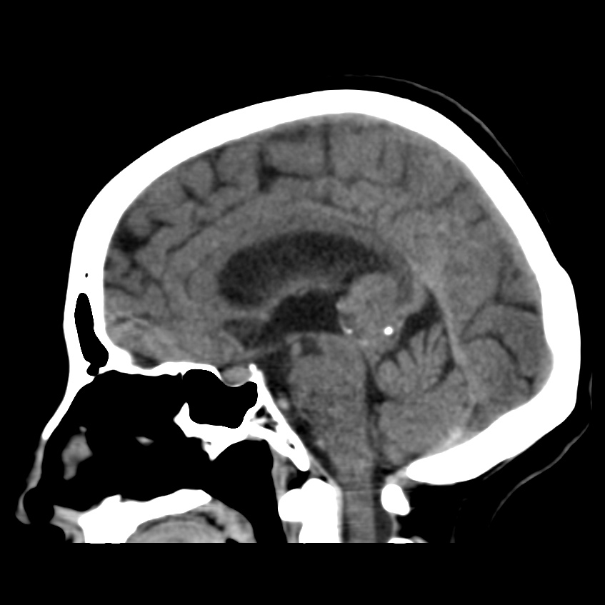 Pineal Tumor Histology Unknown Image Radiopaedia Org