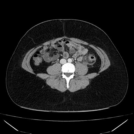 Diverticulitis Summary Radiology Reference Article Radiopaedia Org