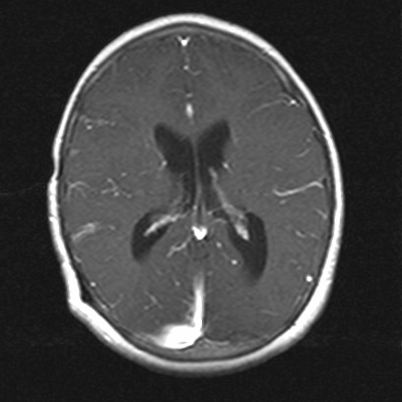 Leptomeningeal Enhancement Radiology Reference Article Radiopaedia Org