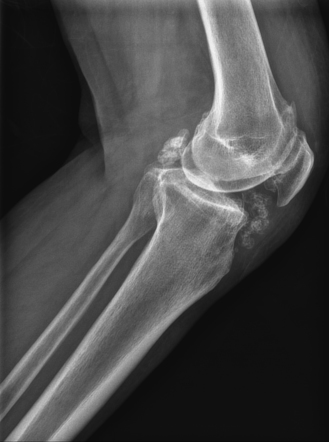 Secondary Synovial Chondromatosis Radiology Reference Article