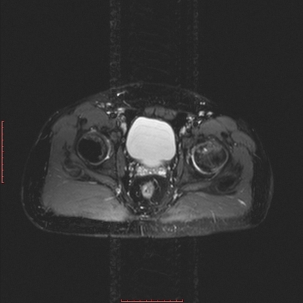 Avascular Necrosis Bilateral Hips Image Radiopaedia Org