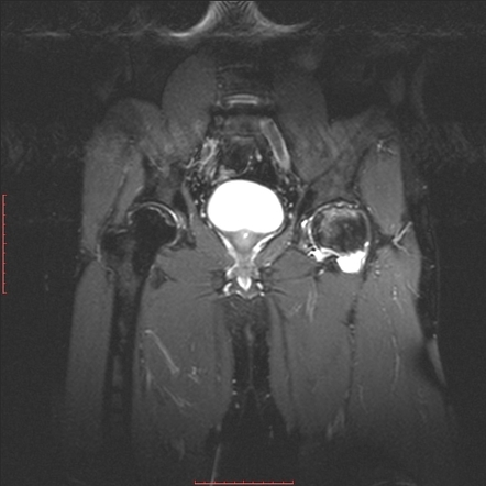 Avascular Necrosis Bilateral Hips Radiology Case Radiopaedia Org