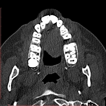 Odontogenic Keratocyst Radiology Case Radiopaedia Org