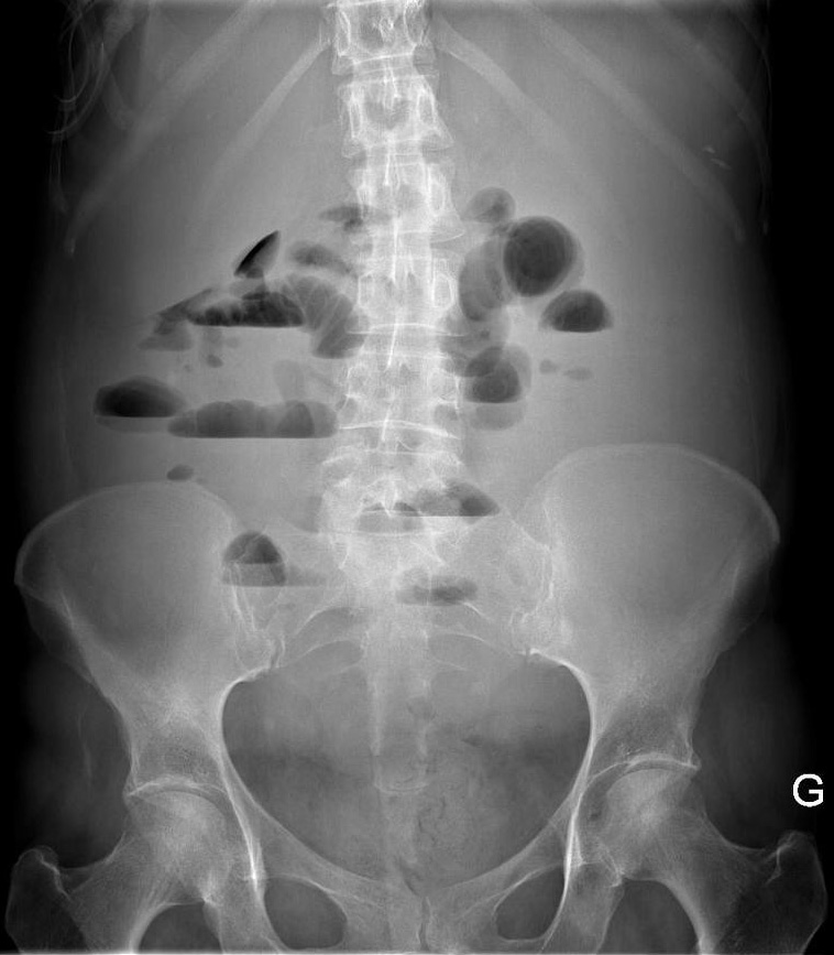 Normal Upright Abdominal X Ray My Xxx Hot Girl