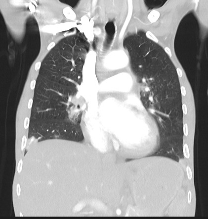 Pulmonary Kaposi Sarcoma Image Radiopaedia Org