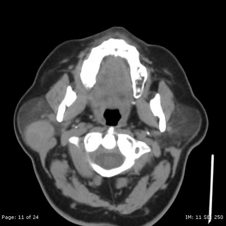 Pleomorphic Adenoma Of The Salivary Glands Radiology Reference