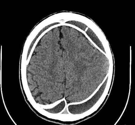 Calcified Chronic Subdural Haematoma Radiology Reference Article Radiopaedia Org