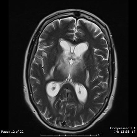 Erdheim Chester Disease With Isolated Involvement Of Cns Image