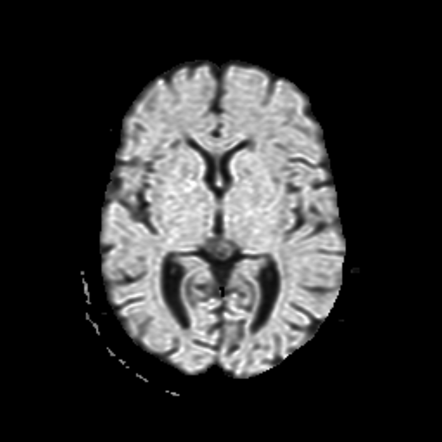 Dwi Schematic Diagram Mri Dwi Mri Brain Midbrain Infarct Seq