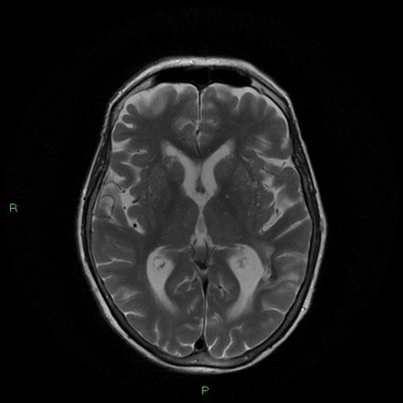 Lobar Intracerebral Hemorrhage Image Radiopaedia Org