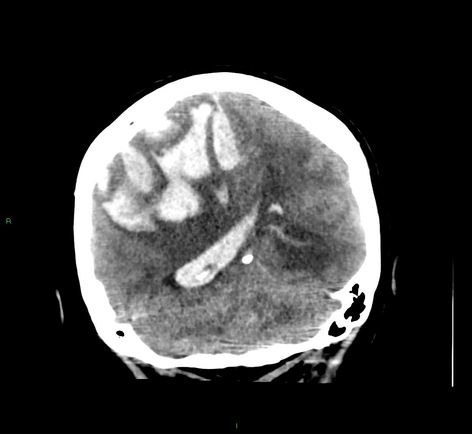 Cerebral Amyloid Angiopathy Associated Lobar Intracerebral Hemorrhage