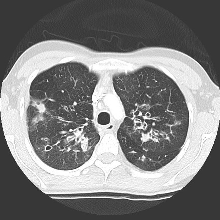 Cystic Fibrosis Pulmonary Manifestations Radiology Reference