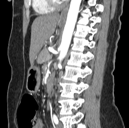 Median Arcuate Ligament Syndrome Image Radiopaedia Org