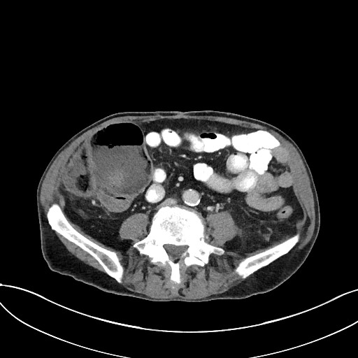 Metastatic Pancreatic Adenocarcinoma Of The Tail With Colon Obstruction