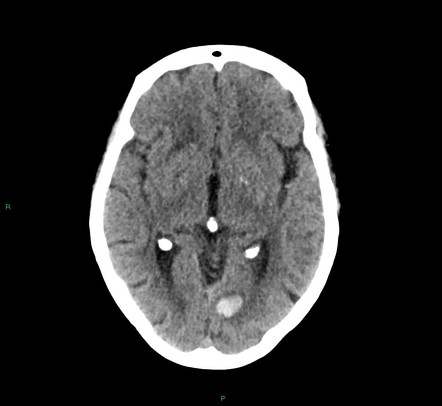 Lobar Intracerebral Haemorrhage Radiology Case Radiopaedia Org