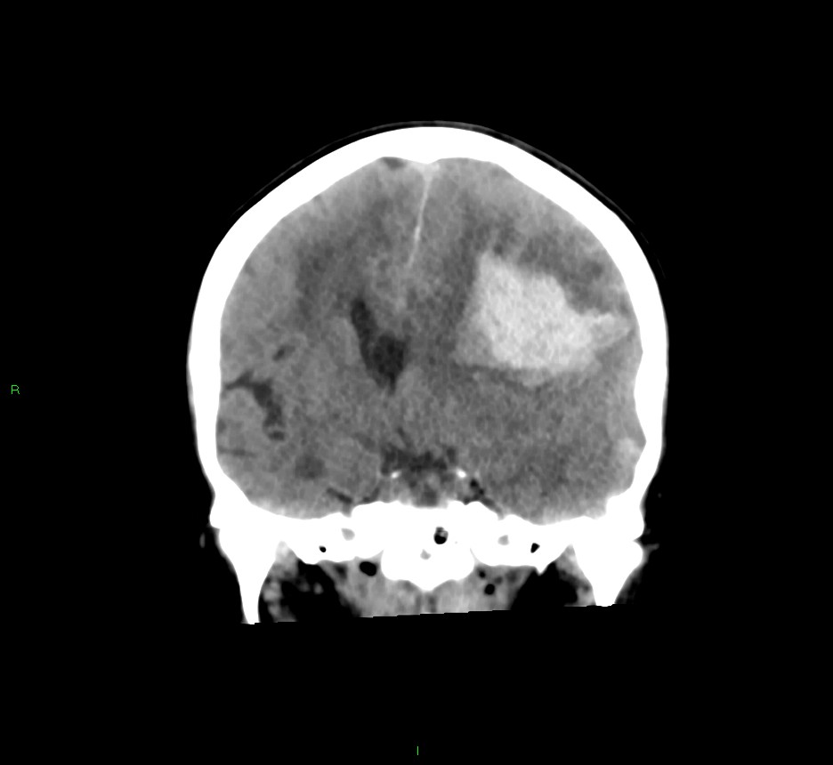 Cerebral Amyloid Angiopathy Associated Lobar Intracerebral Hemorrhage