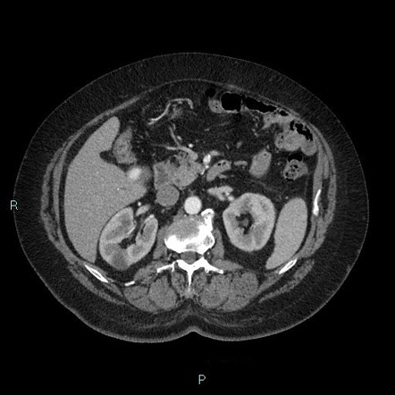 Post Traumatic Hepatic Artery Pseudoaneurysm Image Radiopaedia Org