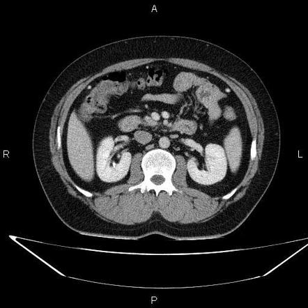 Pancreatic Pseudocyst With Splenic Vein Compression Image