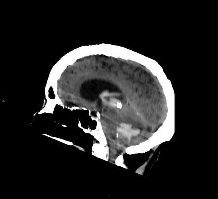 Cerebellar Hemorrhage Radiology Case Radiopaedia Org