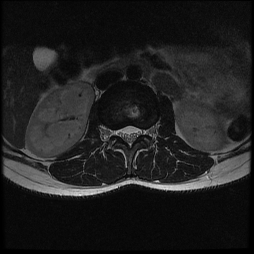 H Shaped Vertebra Image Radiopaedia Org