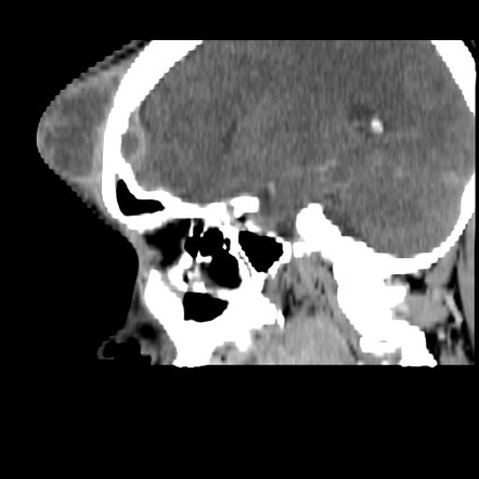 Pott Puffy Tumor Radiology Case Radiopaedia Org