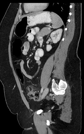 Epiploic Appendagitis A Benign Process At Risk Of