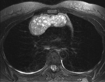 Thymoma WHO Type B3 Radiology Case Radiopaedia Org