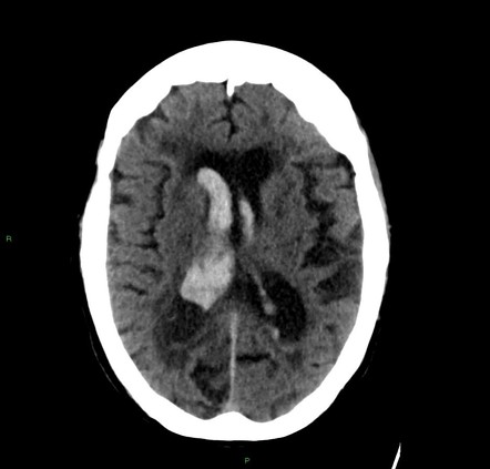 Lobar Intracerebral Hemorrhage Radiology Case Radiopaedia Org