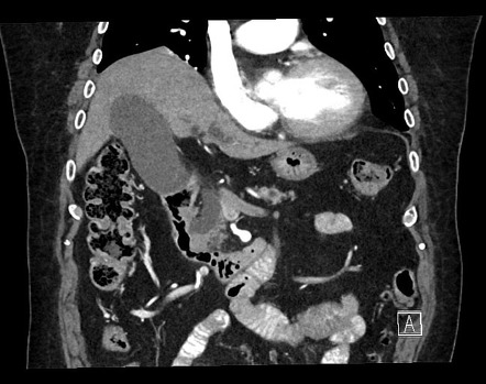 Periampullary Tumors Radiology Reference Article Radiopaedia Org