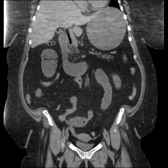 Gallstone Ileus Image Radiopaedia Org