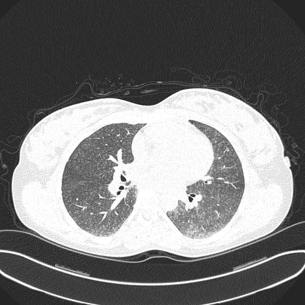 Acute Hypersensitivity Pneumonitis Historical Radiology Reference