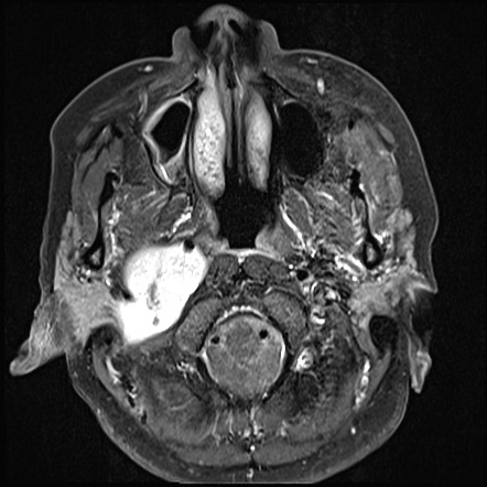 Vagal Nerve Schwannoma Image Radiopaedia Org