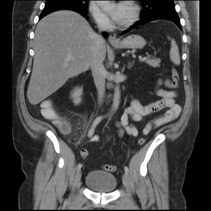 Stump Appendicitis Image Radiopaedia Org