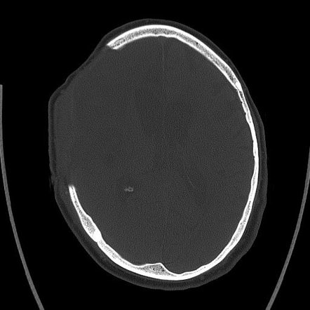 Malignant Middle Cerebral Artery Infarction Image Radiopaedia Org