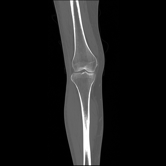 Normal CT Knee Image Radiopaedia Org