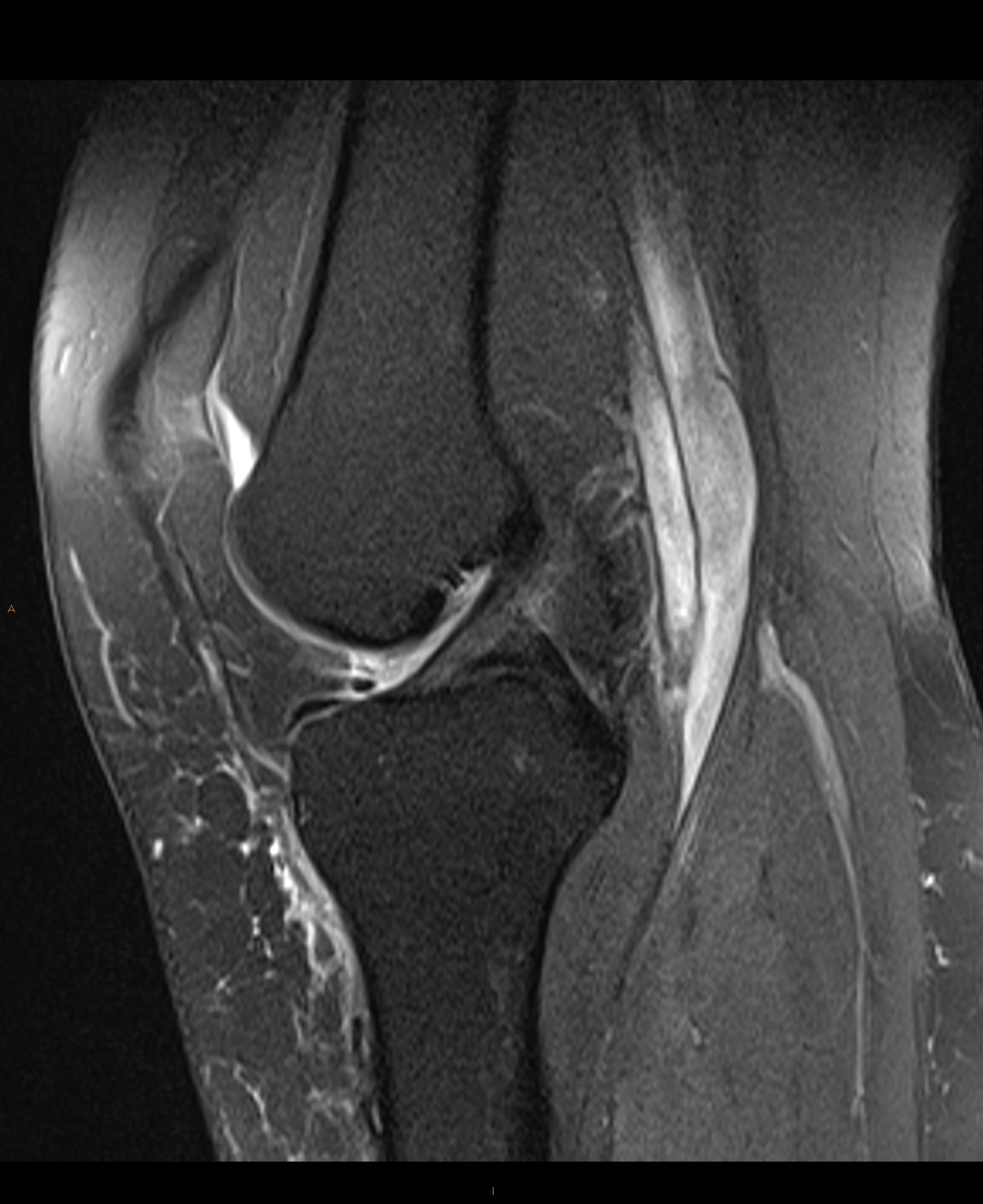 Patellar Instability With Medial Patellofemoral Ligament Tear Image