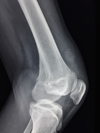 Primary Synovial Chondromatosis Radiology Case Radiopaedia Org