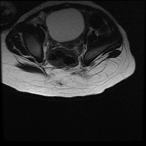 Caudal Regression Syndrome Image Radiopaedia Org