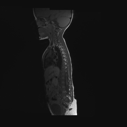 Caudal Regression Syndrome Image Radiopaedia Org