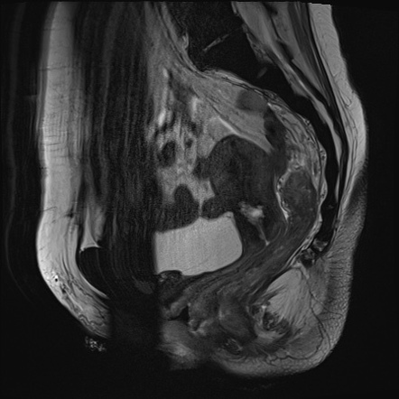 Anovaginal Fistula Image Radiopaedia Org