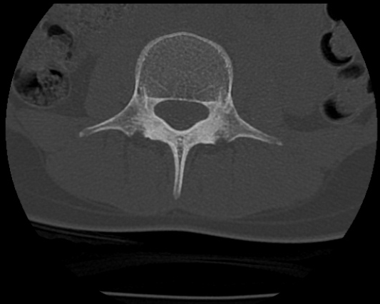 Lumbosacral Transitional Vertebrae Image Radiopaedia Org